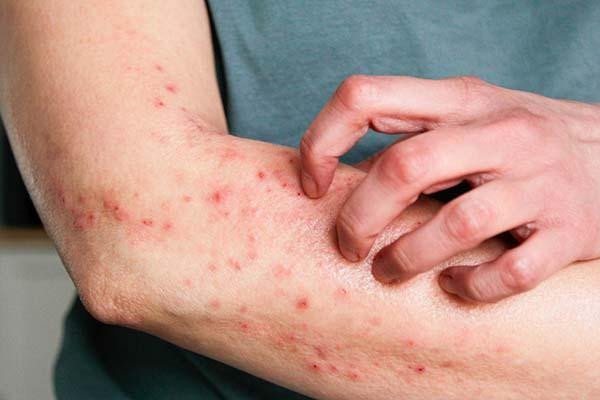 Homeopathic Remedies for Skin Problems & Eczema | Natural Skin Relief
