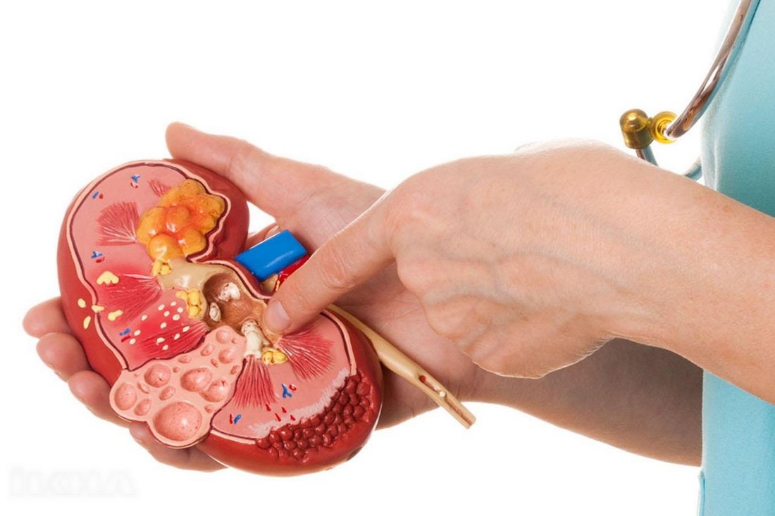 Kidney Stone Homeopathy: Natural Relief Without Surgery